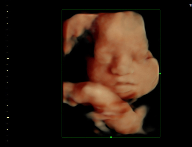 3D ultrasound image at 29 weeks